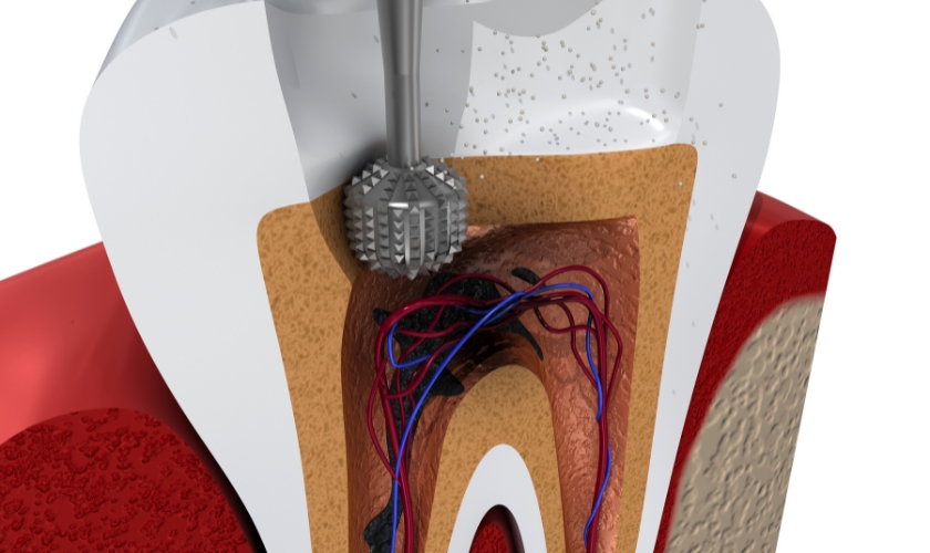 Is root canal painful