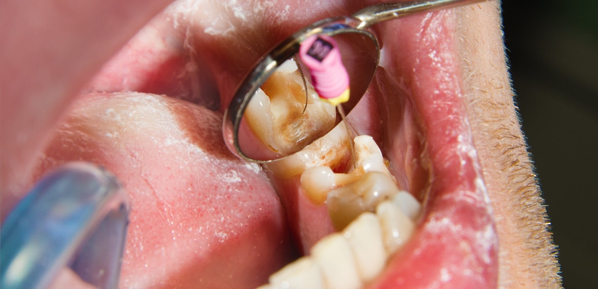 Tooth Extraction vs. Root Canal Making the Right Choice